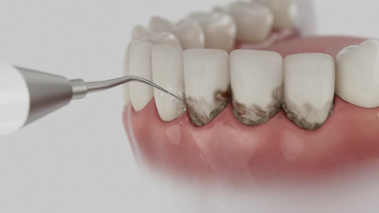 Trusted Wisdom Tooth Removal service in Clute, TX - Dentist Open Now